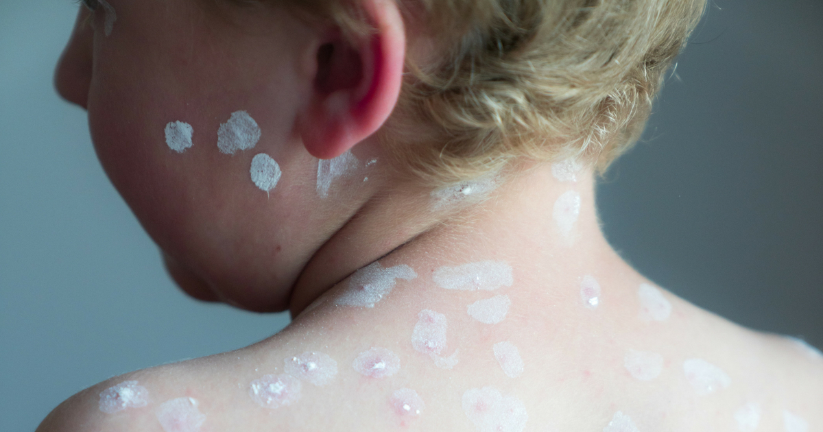 young blond boy shows his back covered in chicken pox blisters and ointment