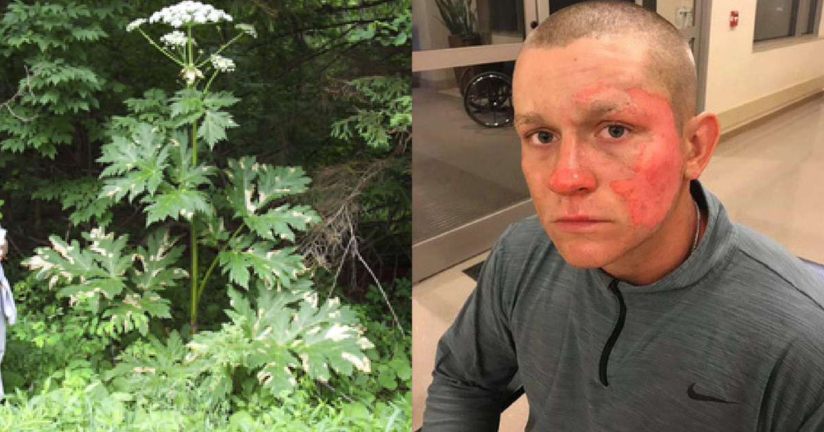 A 17-year-old landscaper from Virginia accidentally brushed against a Giant Hogweed plant, resulting in third-degree burns on his arms and face. He was hospitalized and is doing well.