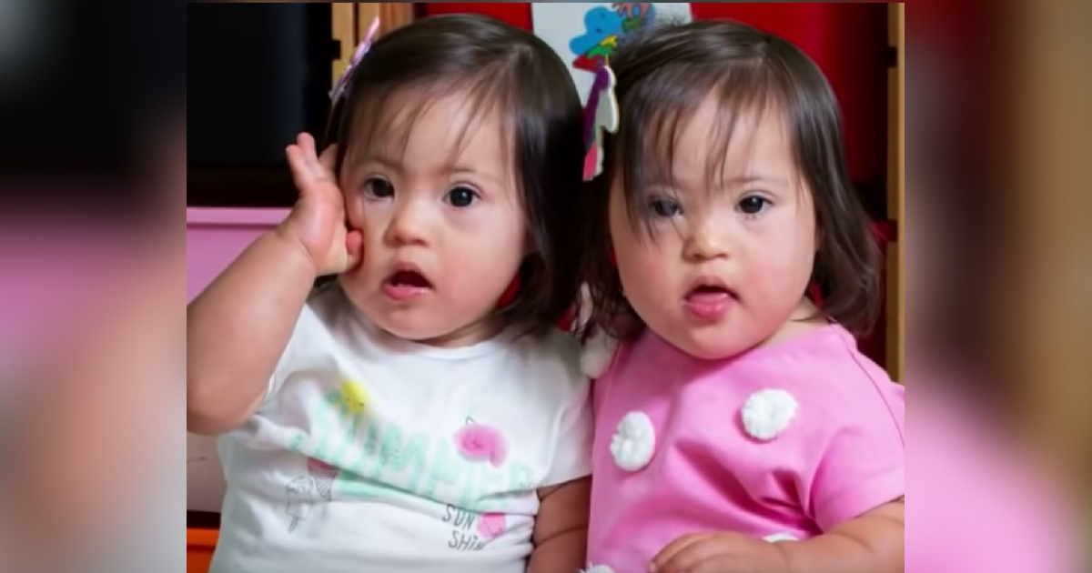 Identical twins with Down syndrome.