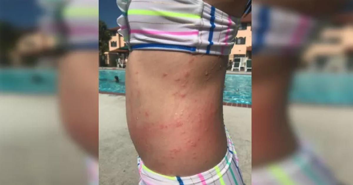Child with rash from sea lice