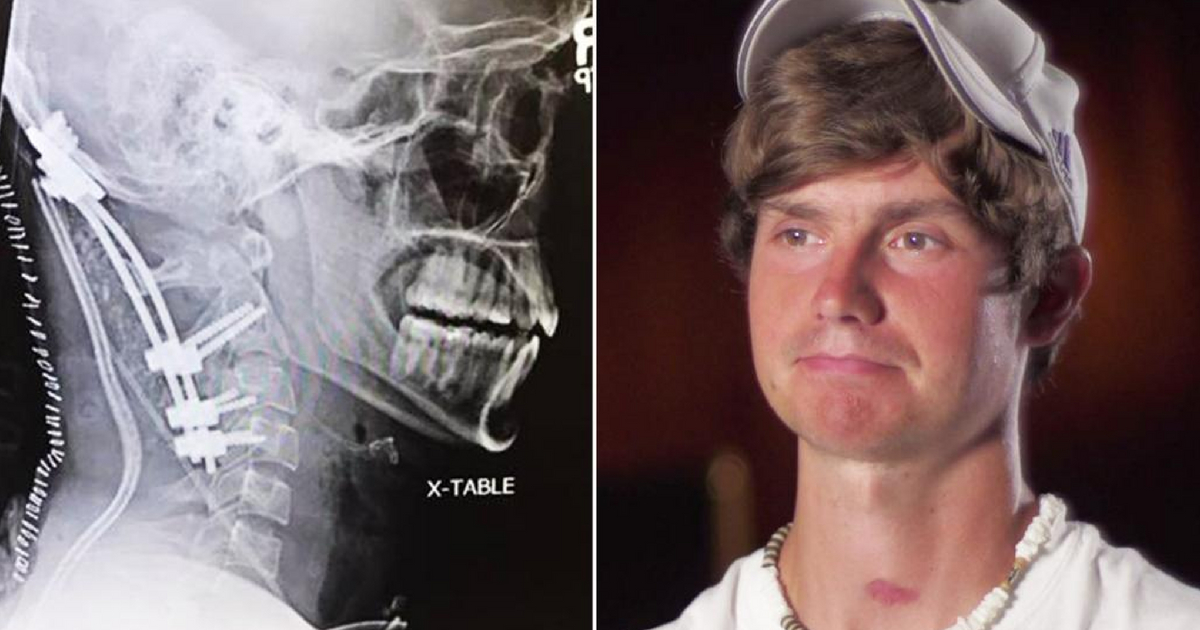 A 22-year-old man survived internal decapitation after surviving a brain tumor.