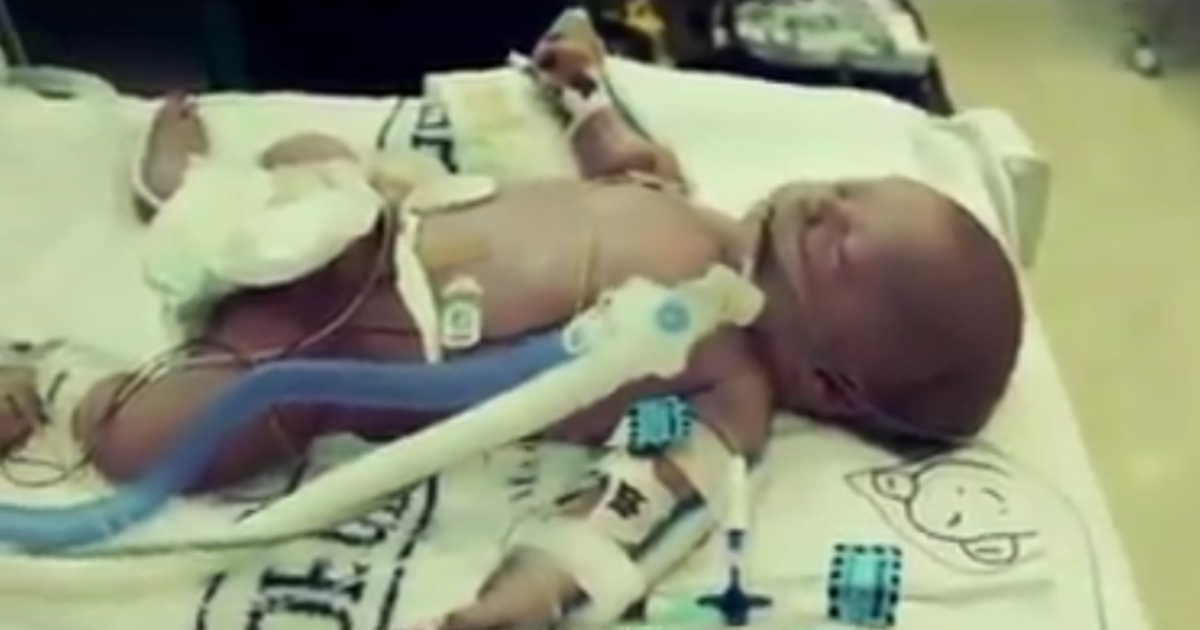 Little baby with a tube in her throat to help her breathe.