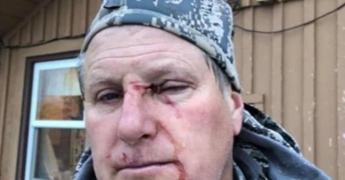 Bob Legasa sports the marks of his encounter with a bear on his face.