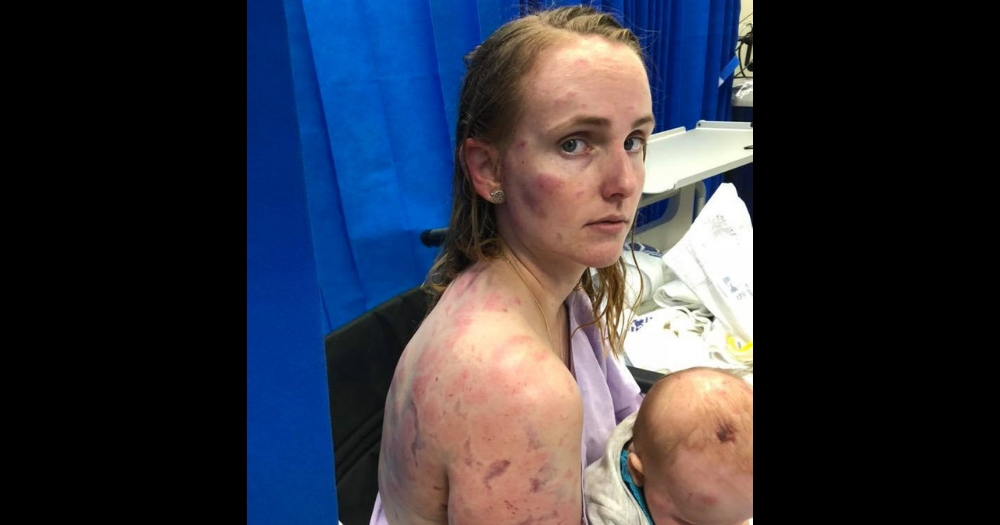Fiona Simpson came away with serious bruises all over her body. 