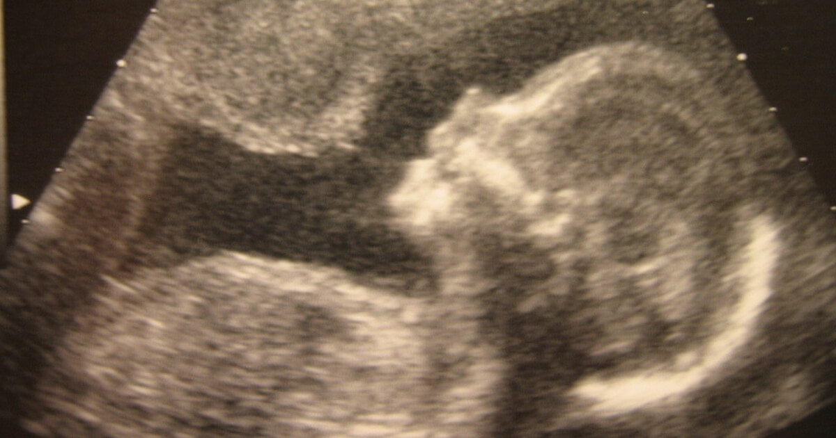 Sonogram image of a baby
