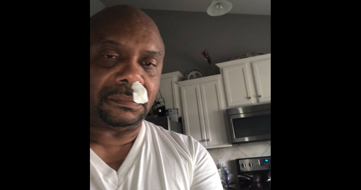 Man with tissue up his nose.