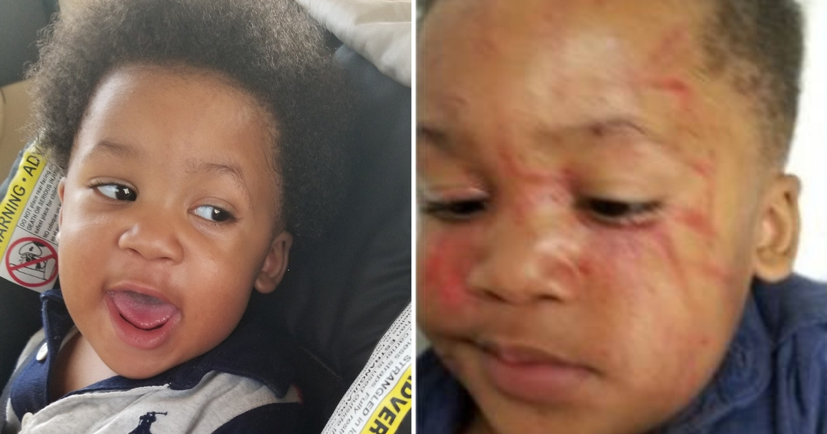 Boy Attacked at Daycare