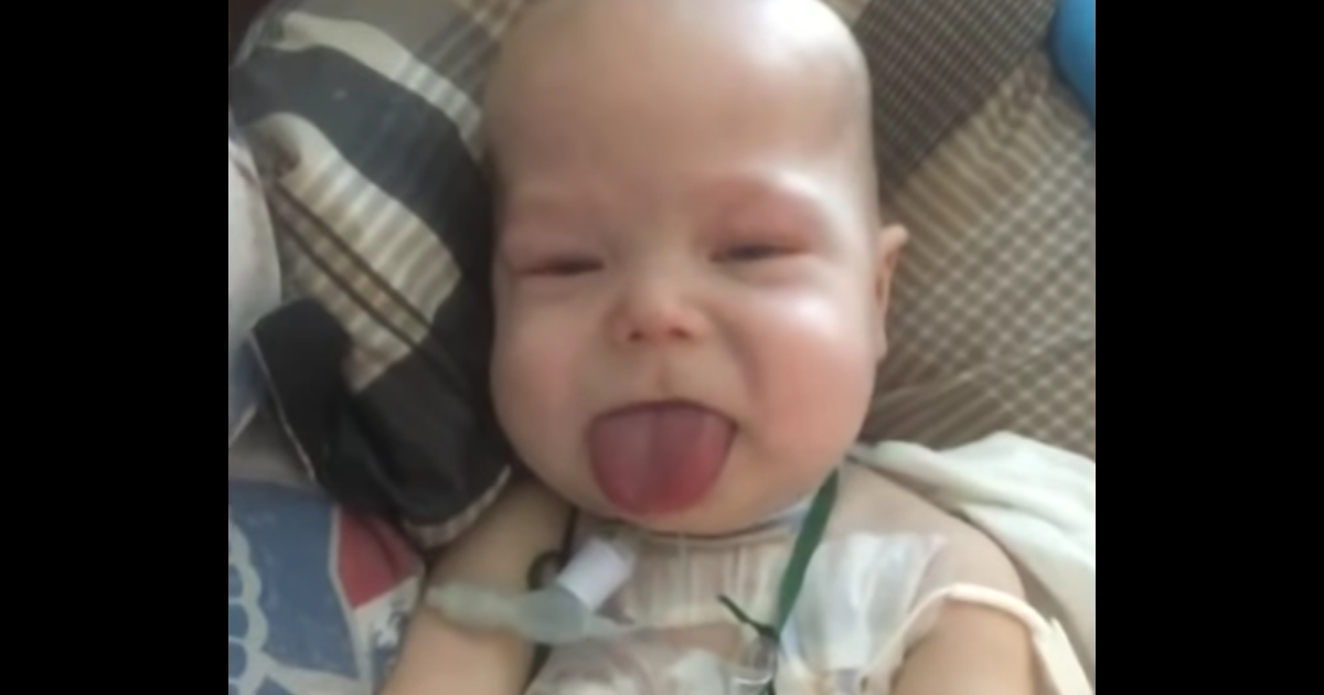 Little boy with abnormally large tongue.