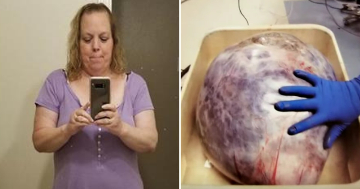 Woman with tumor, left, and the tumor, right.
