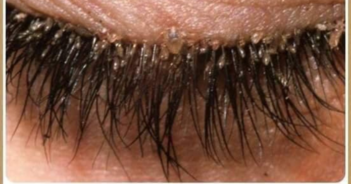 Mites in eye lashes