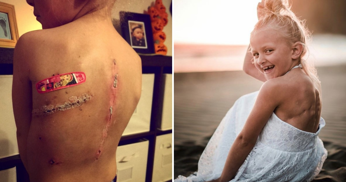Cancer scars, left, and little girl smiling, right.