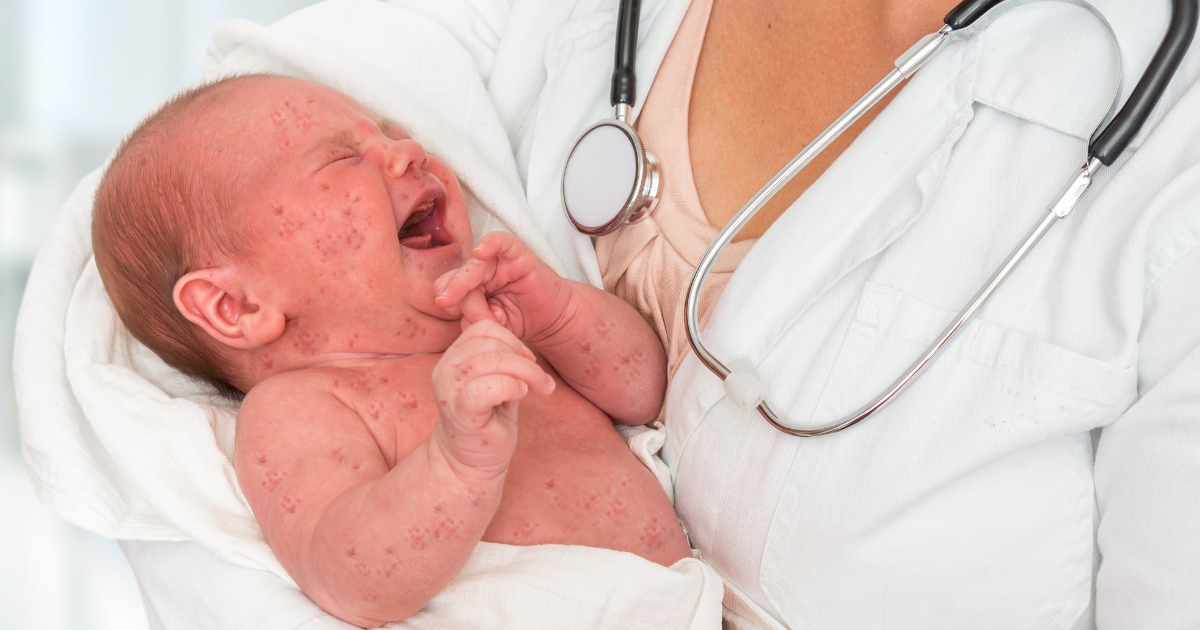 Doctor with stethoscope holding a baby who has measles