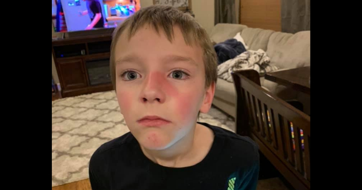 Little boy with red mark across his face.