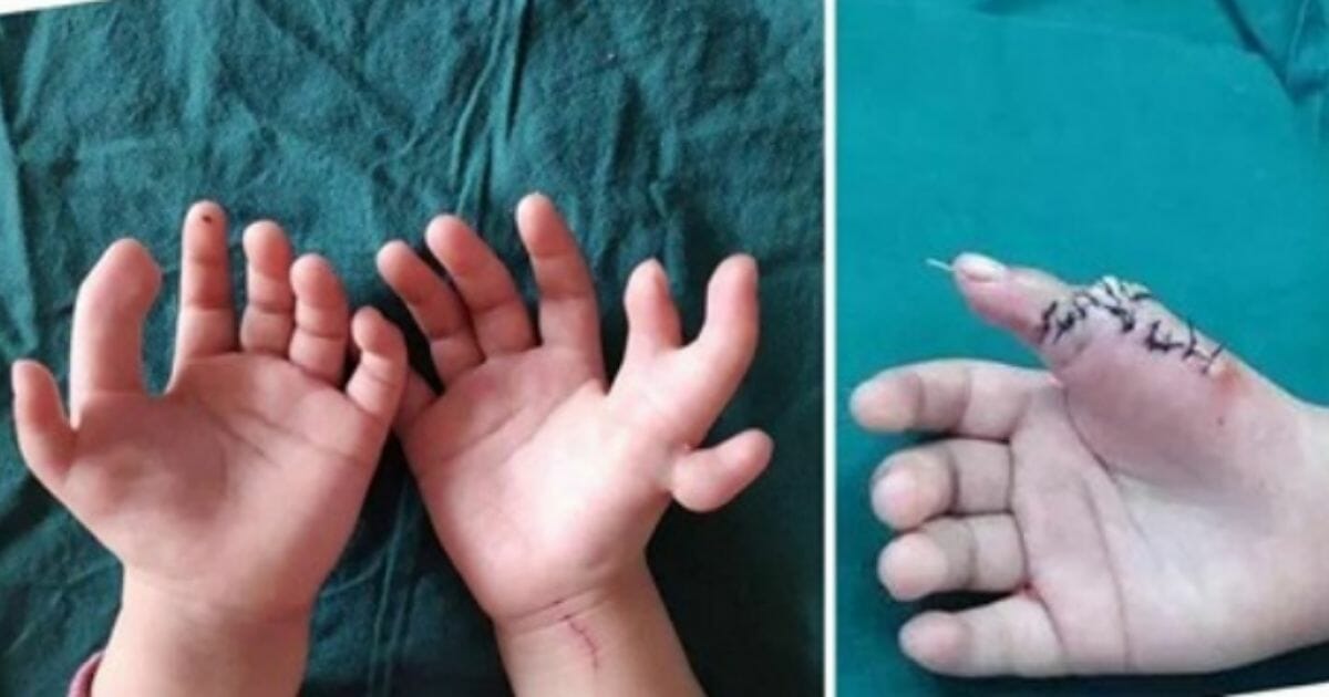 Picture of the girl's hands before surgery, left, and after, right.