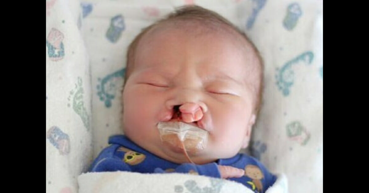 Baby with a cleft palate and lip.