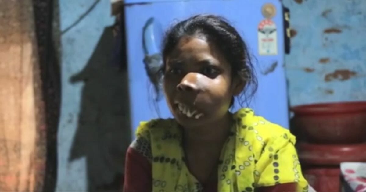 Girl with face tumor