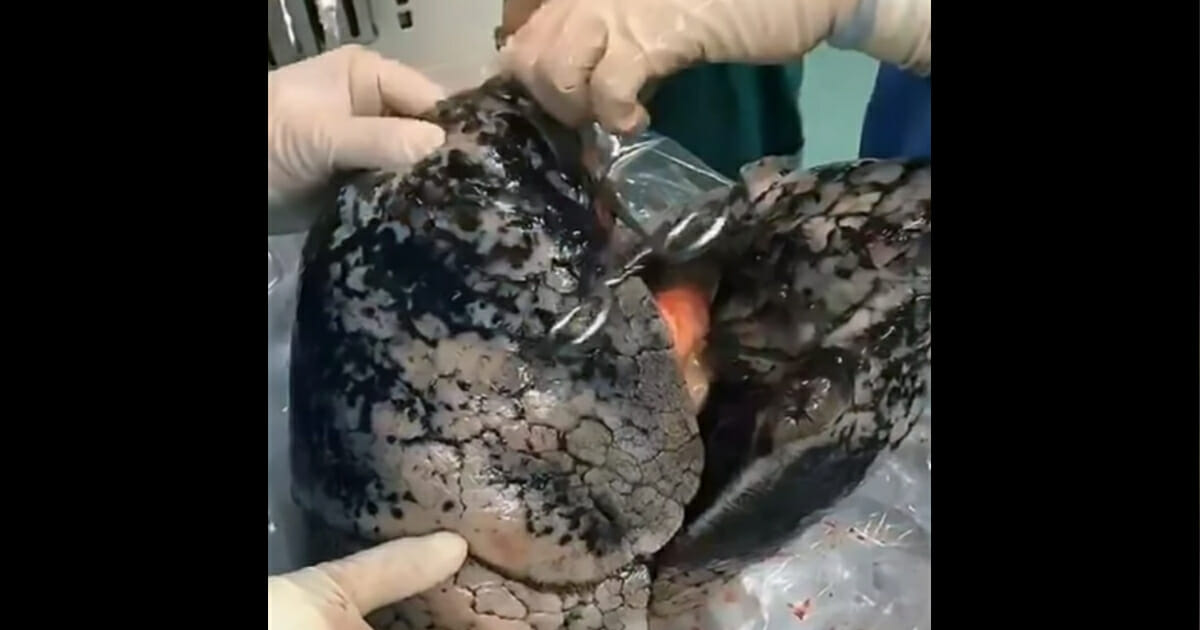 A Chinese chain smoker's blackened lungs.