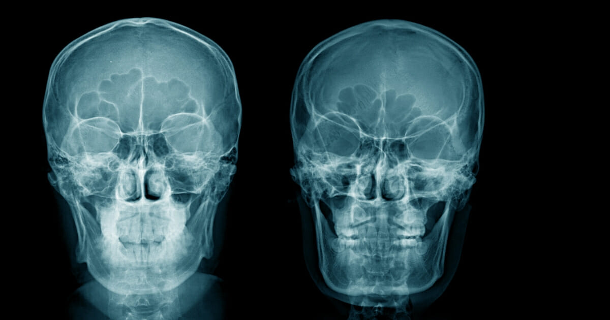 An Australia man's past decisions came back to haunt him after drugs that he tried to smuggle up his nostril stayed lodged in his body for a staggering 18 years. The image above is a stock photo of an x-ray of a head.