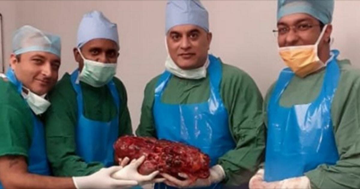 Doctors in New Delhi removed a 16-pound kidney from a 56-year-old man, but they say his remaining kidney is even larger.