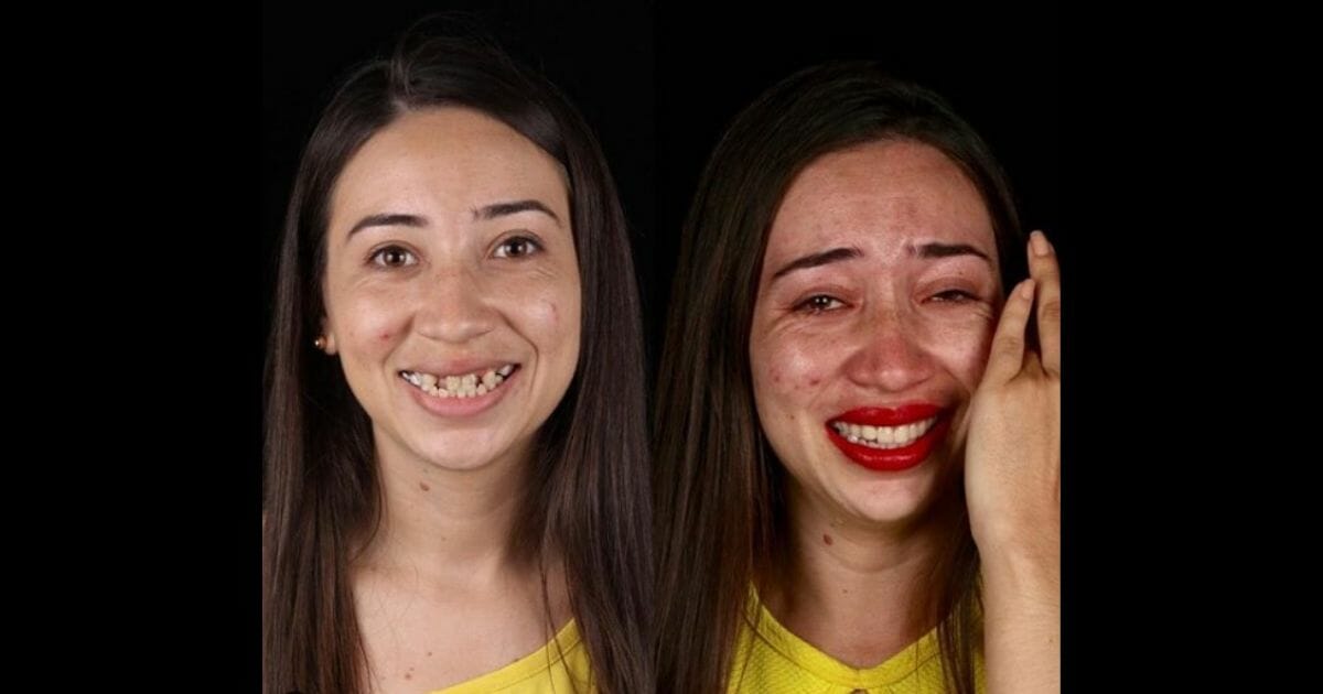 Before and after pictures of a girl's teeth