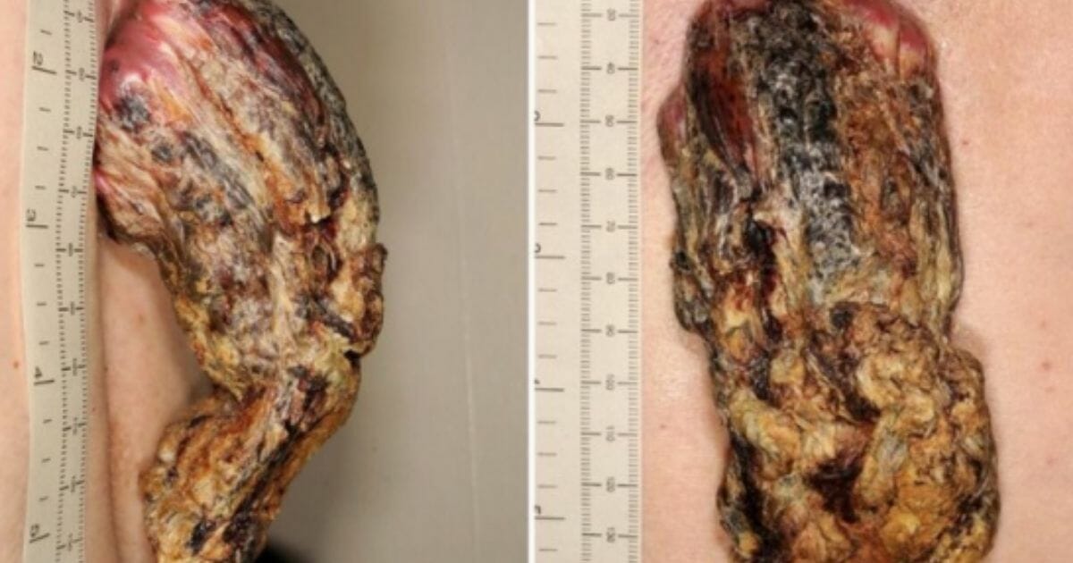 British doctors recently revealed the results of a study conducted on a man who they reported had a cancerous "dragon horn" growth on his back.