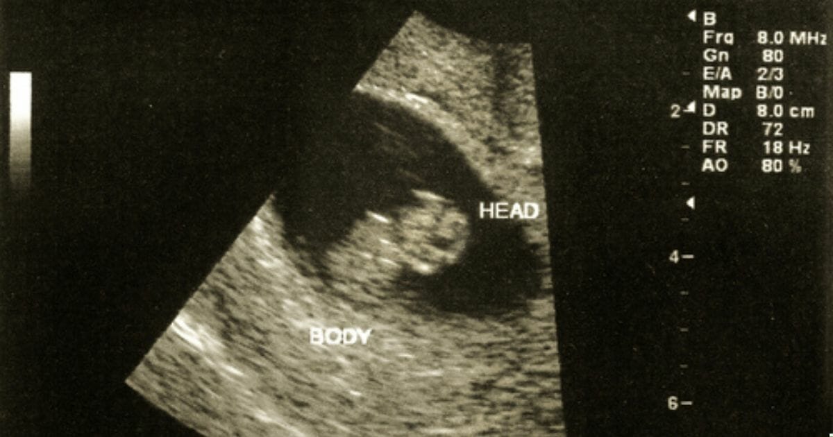 An ultrasound at eight weeks is seen in the stock image above.