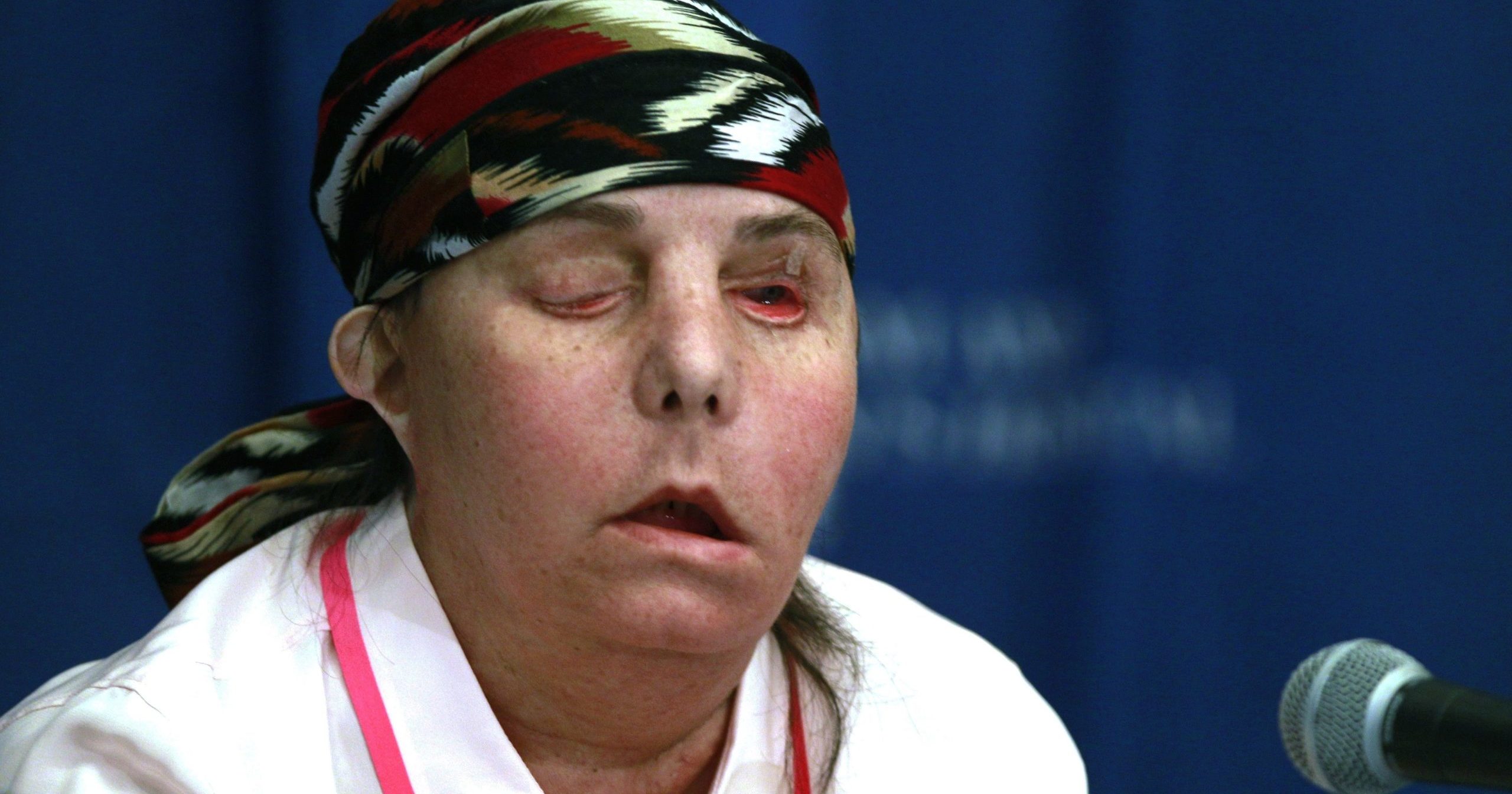 In this May 1, 2013, file photo, Carmen Blandin Tarleton speaks at Brigham and Women's Hospital in Boston following a face transplant. In July 2020, Tarleton became the first American and only the second person globally to undergo a second face transplant procedure after her first transplant failed.