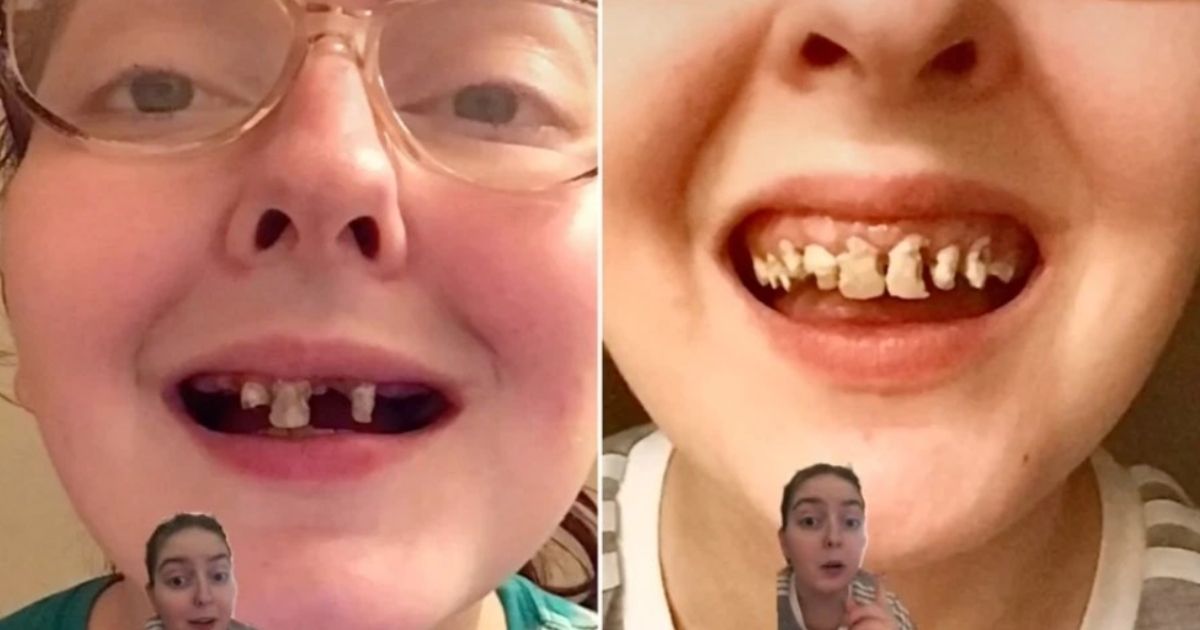 Victoria Irene Nowakowski, a Michigan resident, shows the tooth decay she experienced from a decade-long soda addiction, cigarette habit and poor dental hygiene.