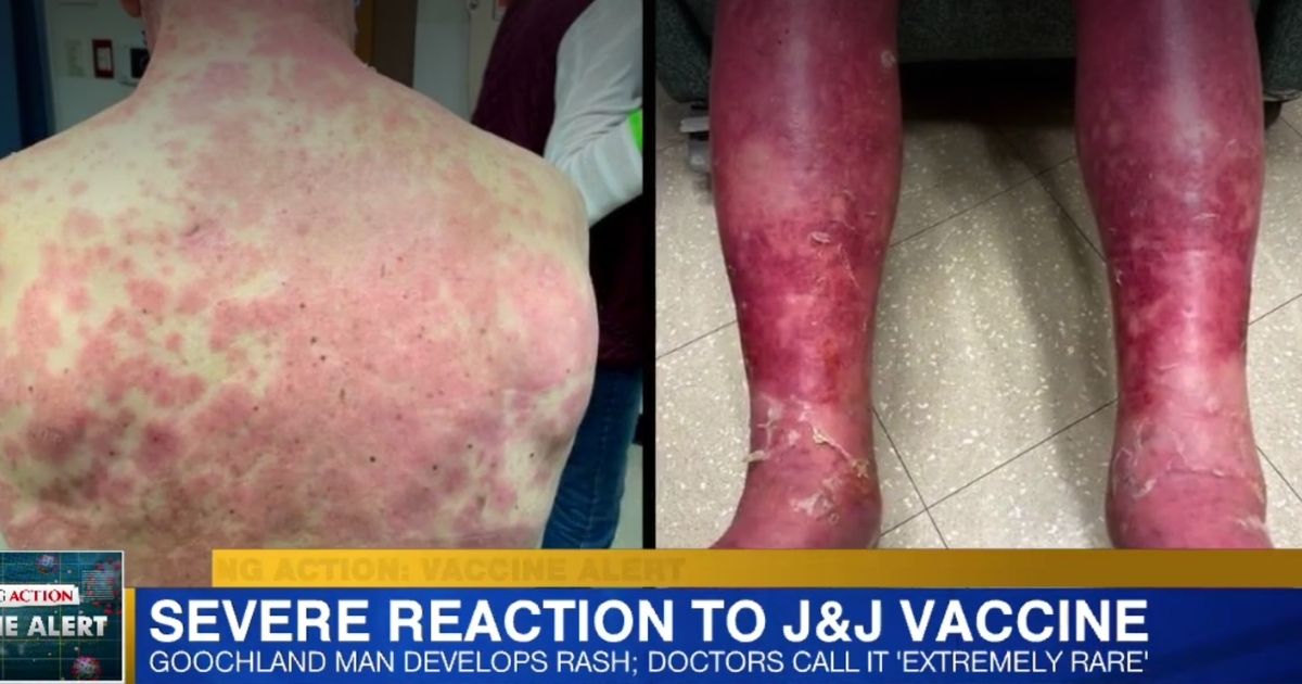 Richard Terrell, 74, of Goochland County, Virginia, received the Johnson & Johnson COVID-19 vaccine on March 6 and four days later, experienced adverse effects.
