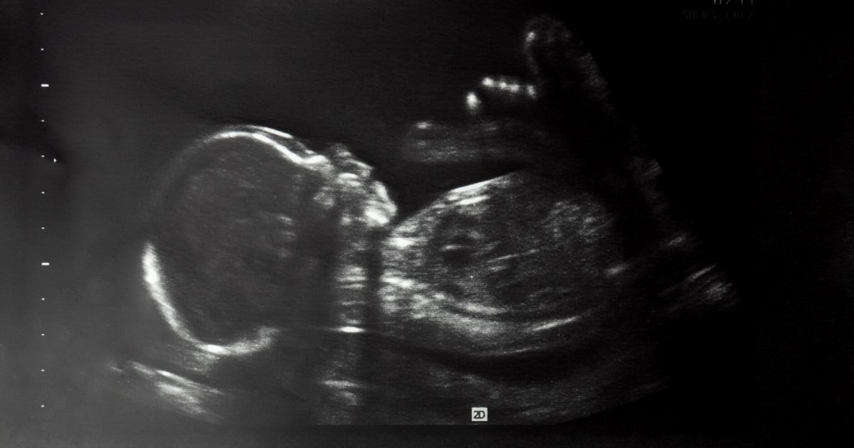 An ultrasound image shows a baby in the mother's womb about 20 weeks into her pregnancy.