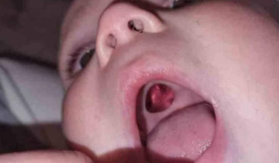 The mother who found this 'hole' in her 10-month-old baby's mouth turned out to be 'embarrassed' when she found out what it really was.