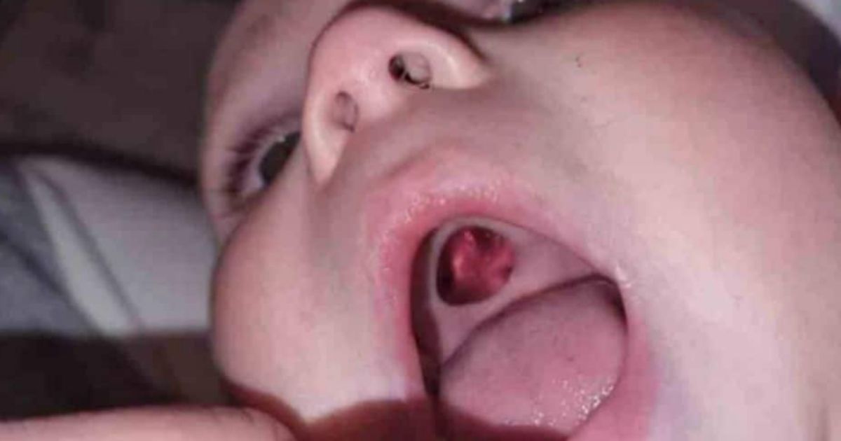 The mother who found this 'hole' in her 10-month-old baby's mouth turned out to be 'embarrassed' when she found out what it really was.