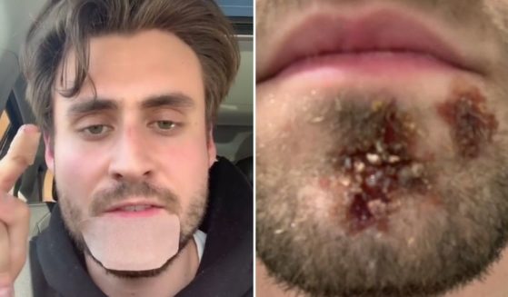 Nick Holterman shares his experience after using his roommate's razor and getting a bacterial infection.