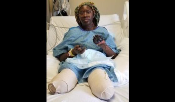 Jummai Nache is seen at the University of Minnesota Medical Center after her legs were amputated.