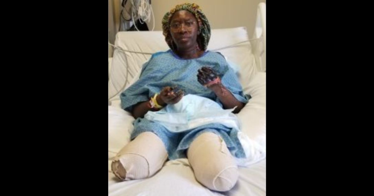 Jummai Nache is seen at the University of Minnesota Medical Center after her legs were amputated.