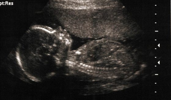 A 20-week-old baby is shown on a sonogram