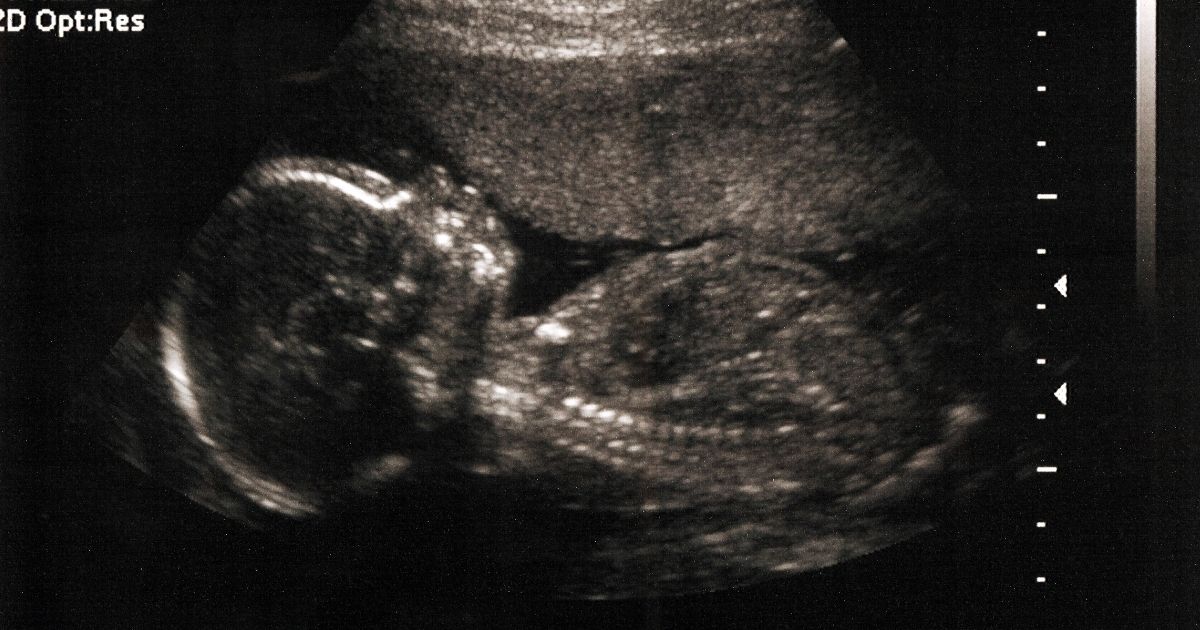 A 20-week-old baby is shown on a sonogram