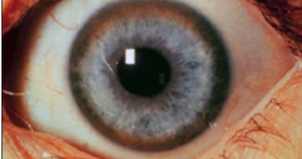 This shows Kayser-Fleischer rings in the eyes of a patient who has been diagnosed with advanced neuropsychiatric Wilson's disease.