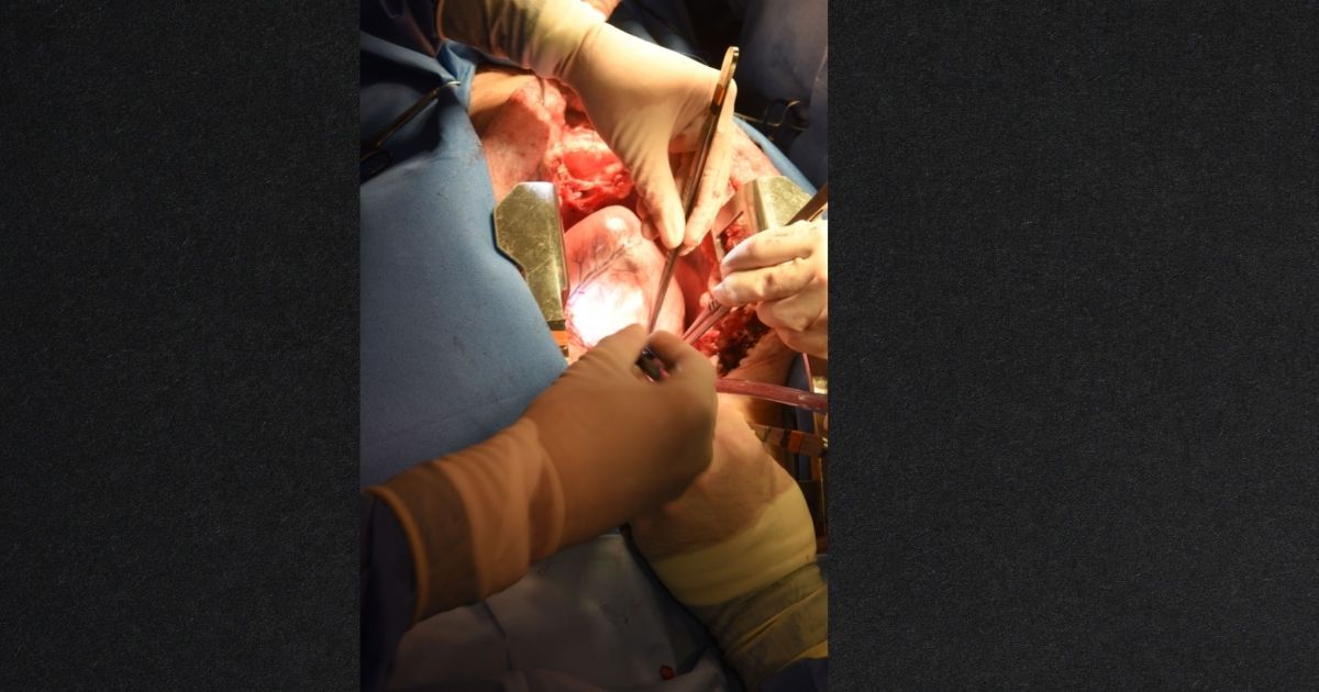 Surgeons transplanted a genetically modified pig heart into a 57-year-old man this month in a groundbreaking procedure that provides a possible solution to the shortage of donor organs.