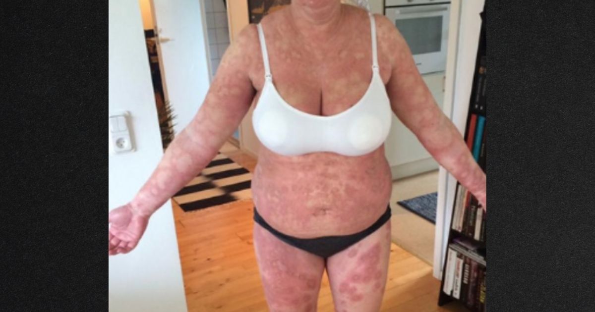The rare autoimmune disease can cause itchy, painful welts all over the expectant mom's body.