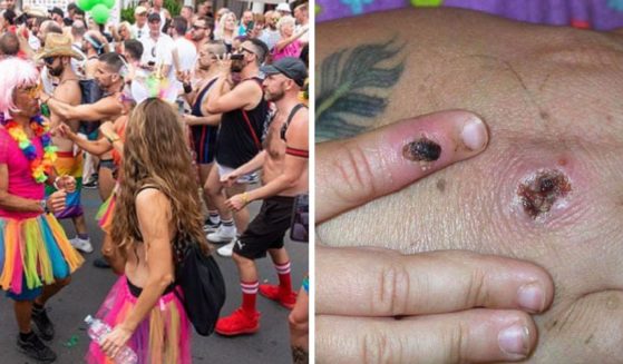 Maspolamas Pride scene, left; monkeypox lesion on a hand, right.
