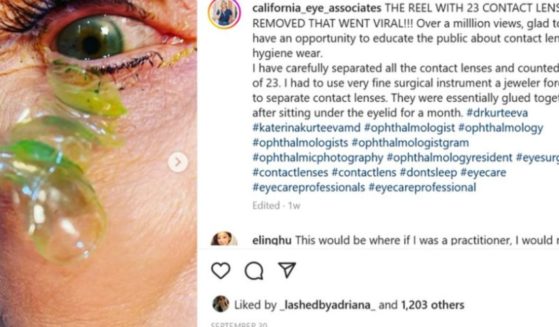 Newport Beach, California, ophthalmologist Dr. Katerina Kurteeva removed 23 contact lenses from a patient's eye. "In nearly 20 years of practice, I had never seen anything like it," Kurteeva said.