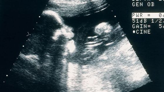 An ultrasound shows a baby in the womb.