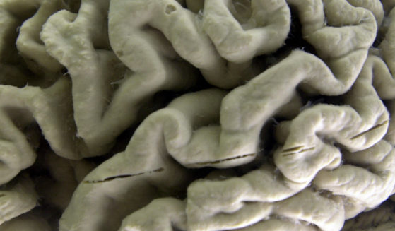 This 2003 file photo shows a closeup of a human brain affected by Alzheimer's disease. The photo is on display at the Museum of Neuroanatomy at the University at Buffalo.