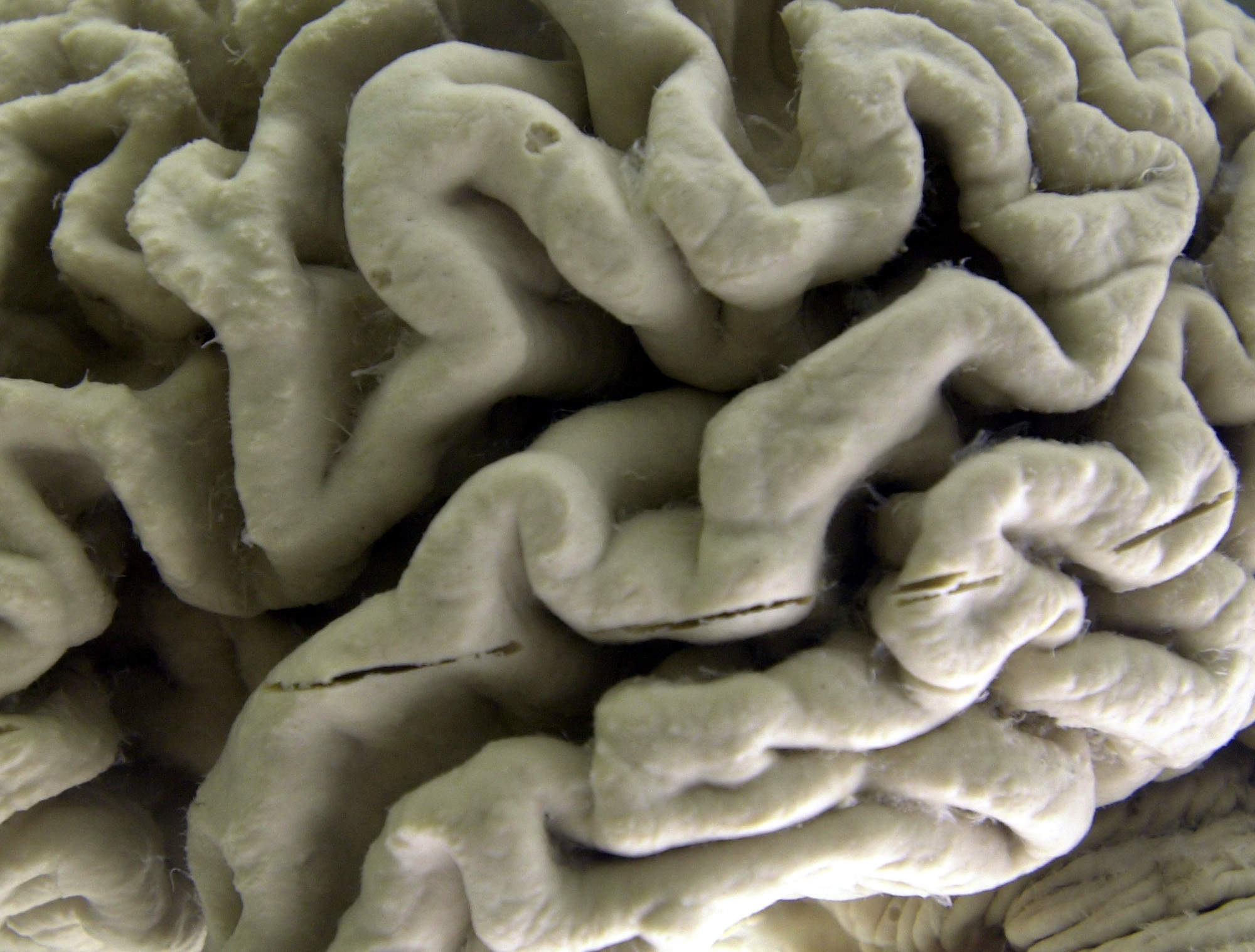 This 2003 file photo shows a closeup of a human brain affected by Alzheimer's disease. The photo is on display at the Museum of Neuroanatomy at the University at Buffalo.
