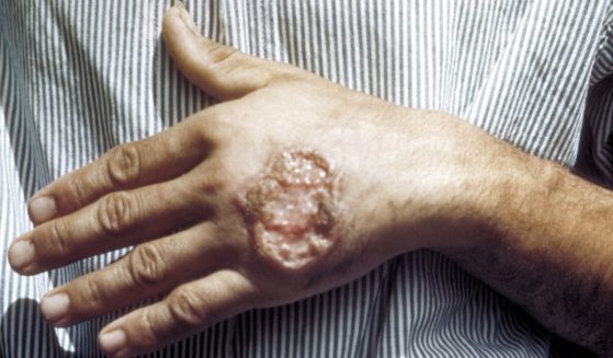 Skin ulcer due to leishmaniasis, on the hand of a Central American man.