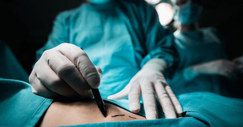 A close-up of a plastic surgeon marking the human skin for surgery.
