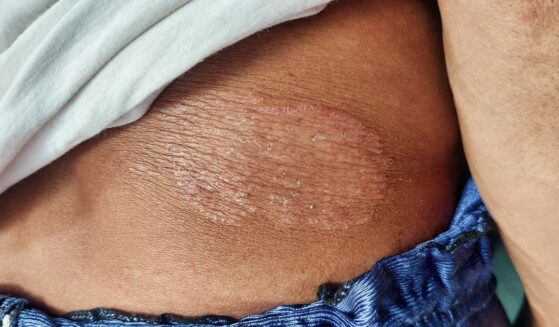 A close-up of a circular, red, and scaly rash on a person's torso, characteristic of a ringworm fungal infection or nummular eczema.