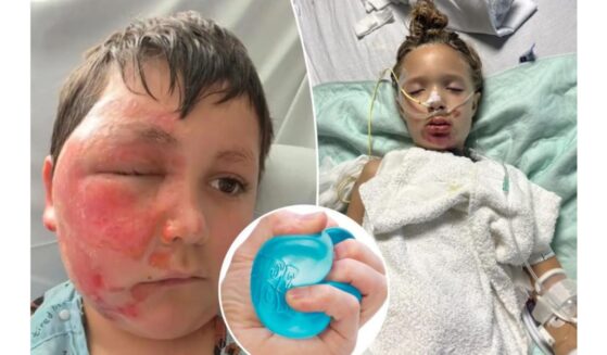 Children have been severely burned by following a popular TikTok trend.
